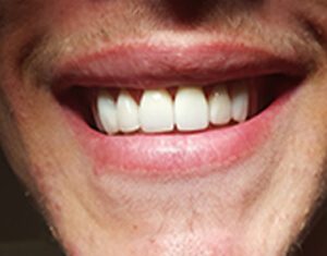after dental crowns to correct spaces